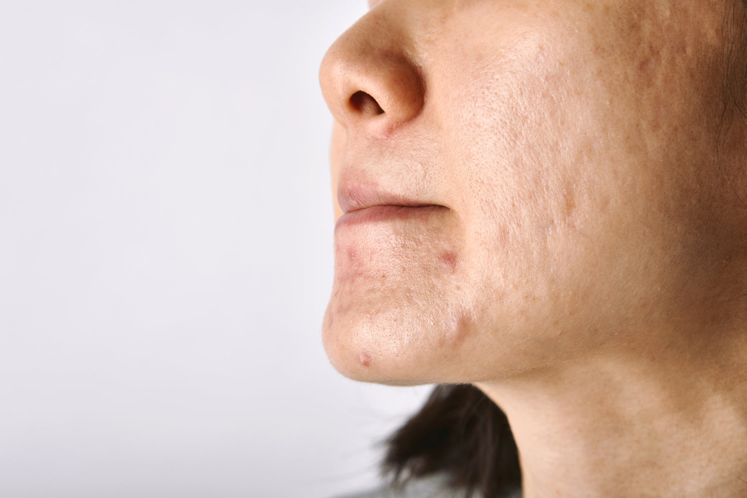 Acne - What causes it and how you treat it – Vivid.Edible.Skincare